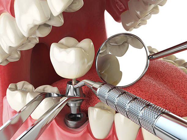 Best Emergency Wisdom Tooth Extraction in Caddo Mills, TX