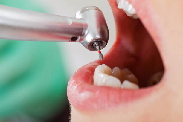 Best Dental Abscess Treatment in Caddo Mills, TX
